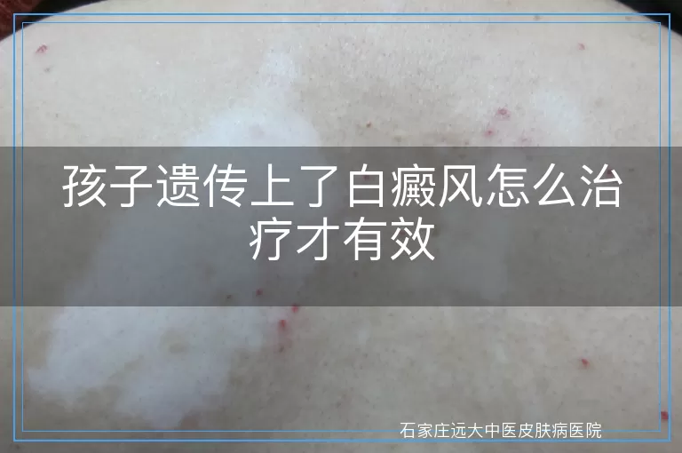 孩子遗传上了白癜风怎么治疗才有效