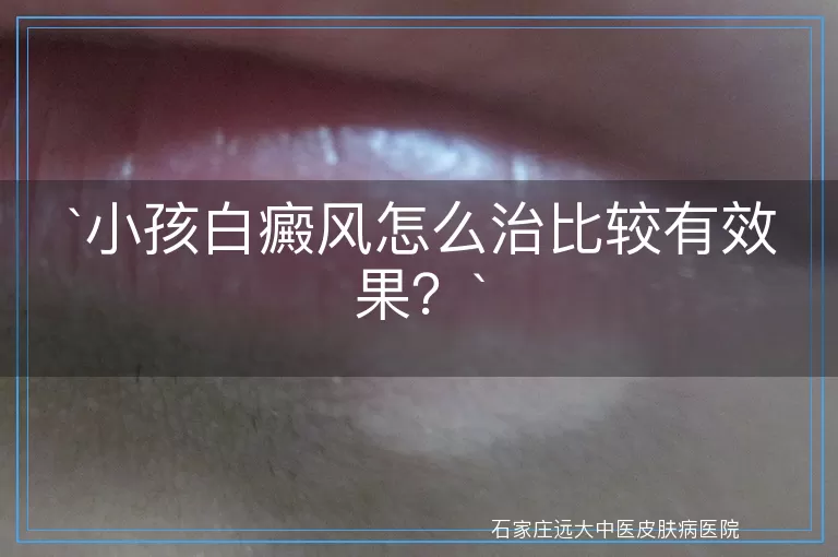小孩白癜风怎么治比较有效果？