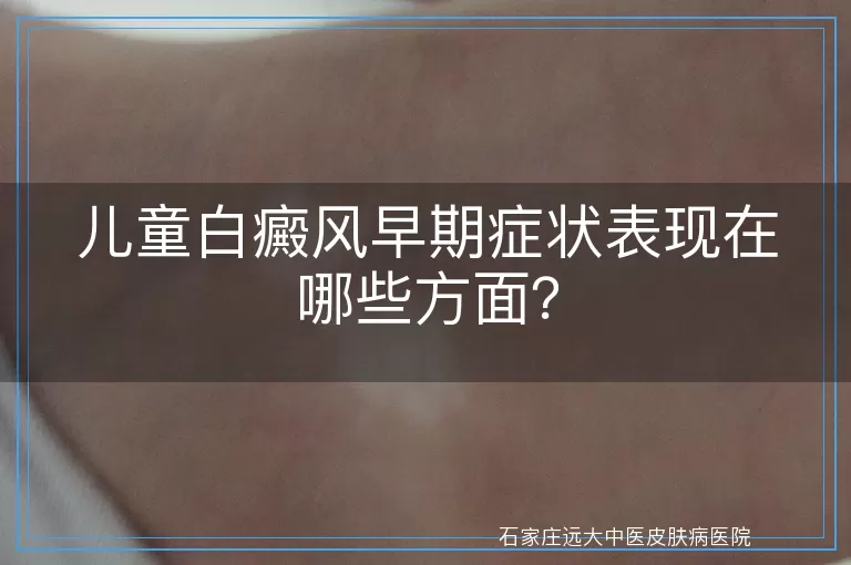 儿童白癜风早期症状表现在哪些方面？