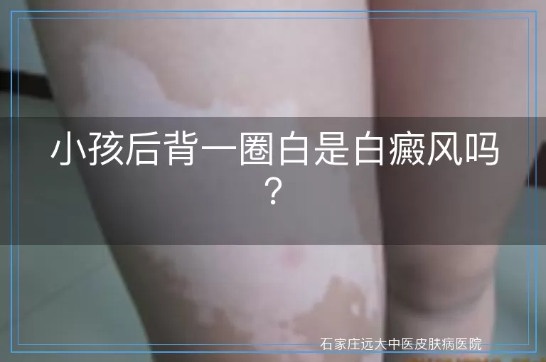 小孩后背一圈白是白癜风吗？