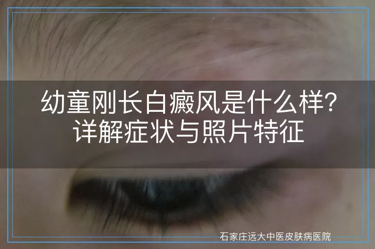 幼童刚长白癜风是什么样？详解症状与照片特征