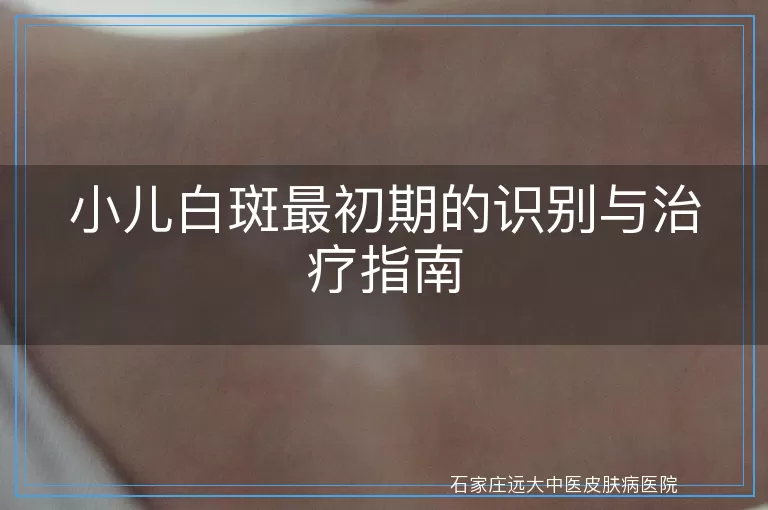 小儿白斑最初期的识别与治疗指南