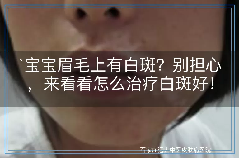 宝宝眉毛上有白斑？别担心，来看看怎么治疗白斑好！