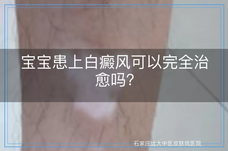 宝宝患上白癜风可以完全治愈吗？