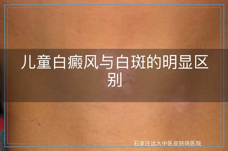 儿童白癜风与白斑的明显区别