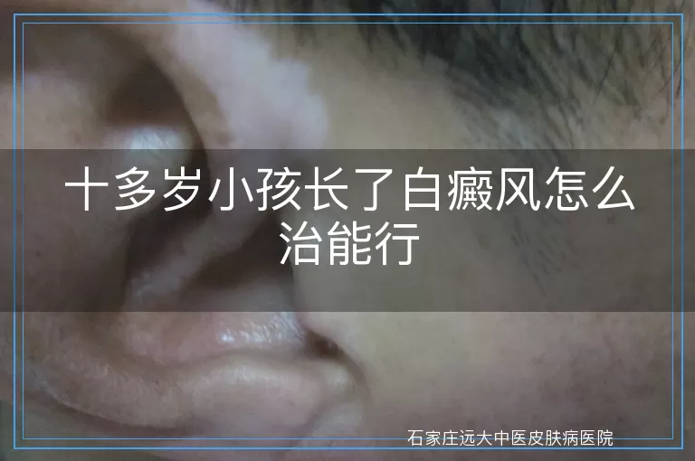 十多岁小孩长了白癜风怎么治能行