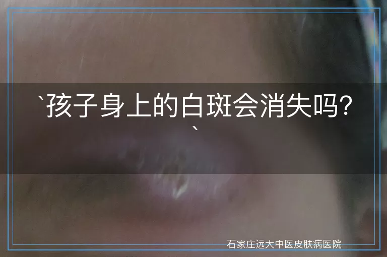 孩子身上的白斑会消失吗？