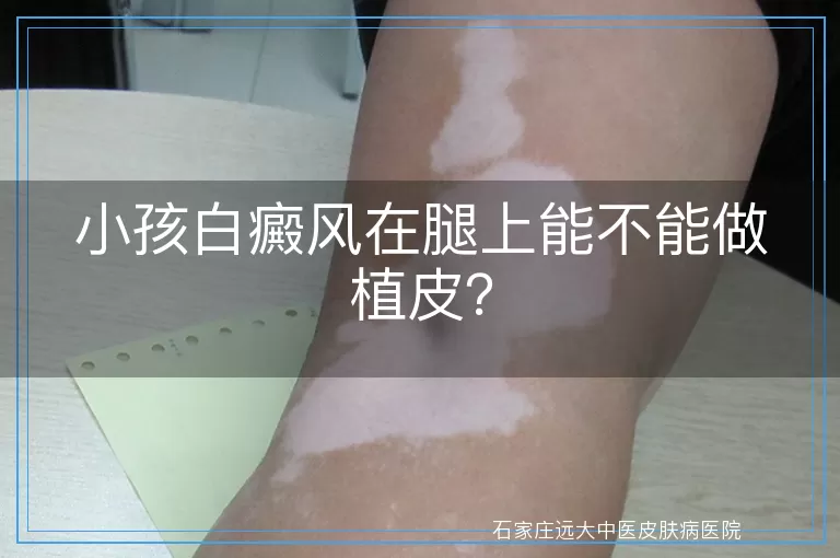 小孩白癜风在腿上能不能做植皮？