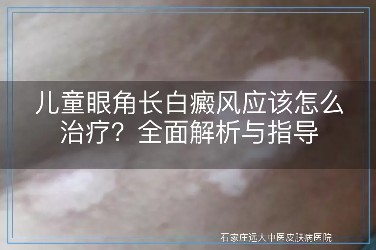 儿童眼角长白癜风应该怎么治疗？全面解析与指导