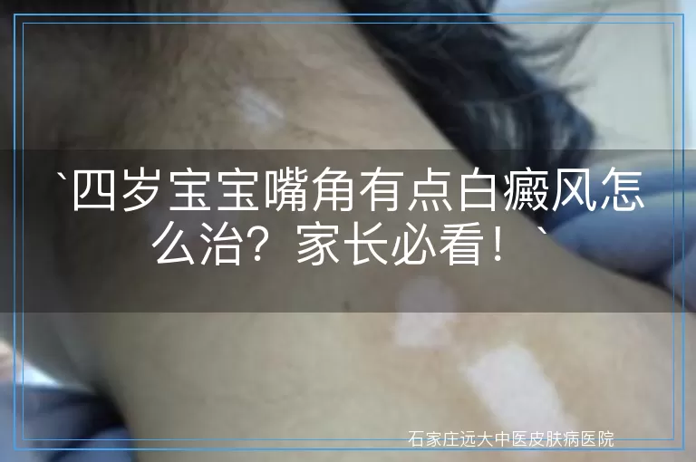 四岁宝宝嘴角有点白癜风怎么治？家长必看！