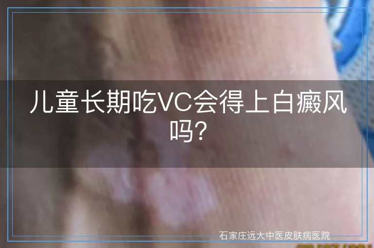 儿童长期吃VC会得上白癜风吗？