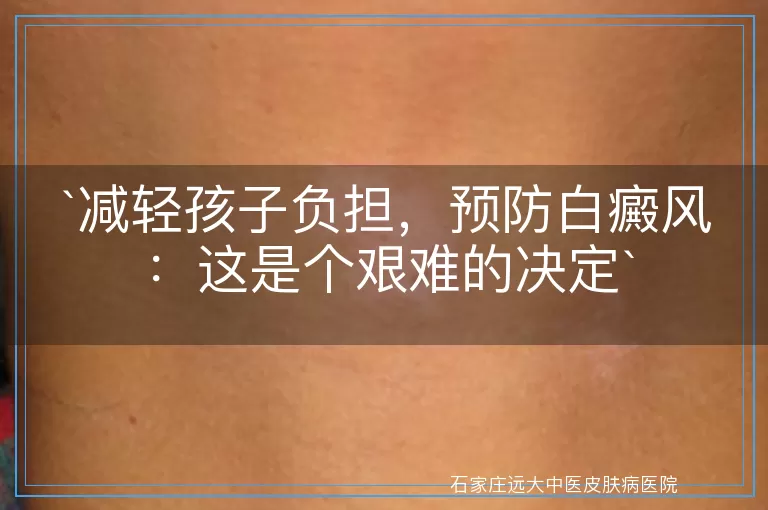 减轻孩子负担，预防白癜风：这是个艰难的决定