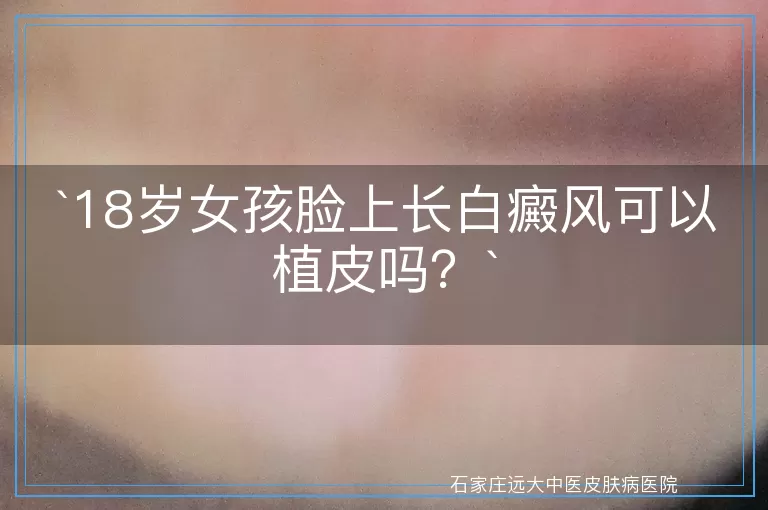 18岁女孩脸上长白癜风可以植皮吗？