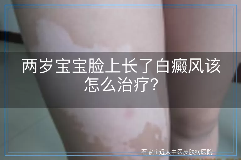 两岁宝宝脸上长了白癜风该怎么治疗？