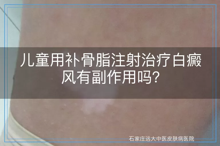 儿童用补骨脂注射治疗白癜风有副作用吗？
