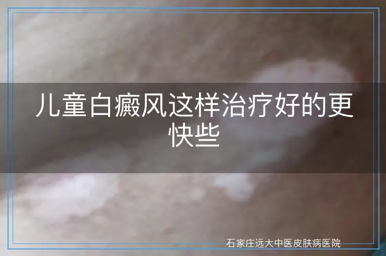 儿童白癜风这样治疗好的更快些