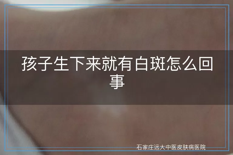 孩子生下来就有白斑怎么回事