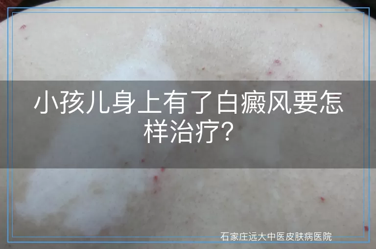 小孩儿身上有了白癜风要怎样治疗？