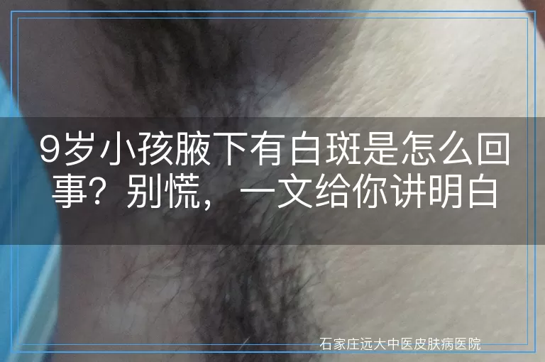 9岁小孩腋下有白斑是怎么回事？别慌，一文给你讲明白！