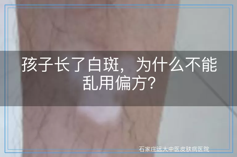 孩子长了白斑，为什么不能乱用偏方？