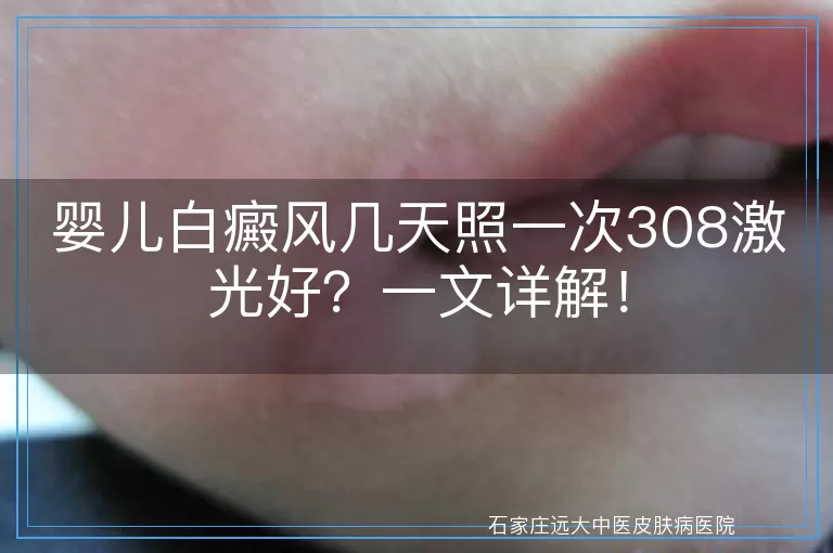 婴儿白癜风几天照一次308激光好？一文详解！