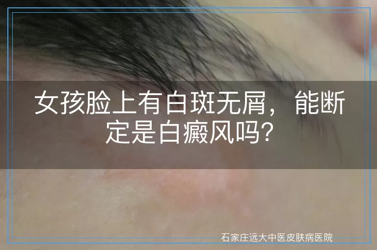 女孩脸上有白斑无屑，能断定是白癜风吗？