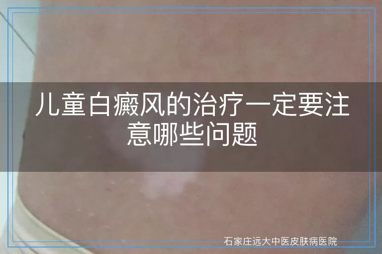 儿童白癜风的治疗一定要注意哪些问题