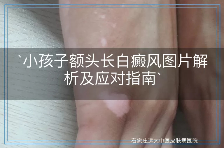 小孩子额头长白癜风图片解析及应对指南