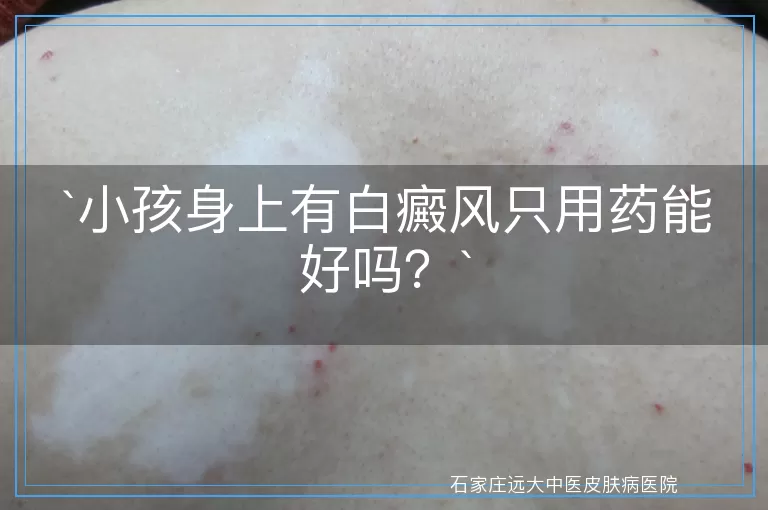 小孩身上有白癜风只用药能好吗？