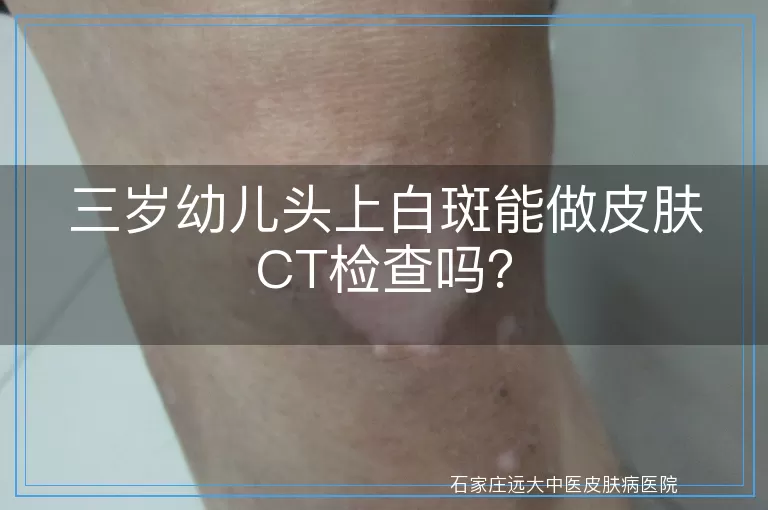 三岁幼儿头上白斑能做皮肤CT检查吗？