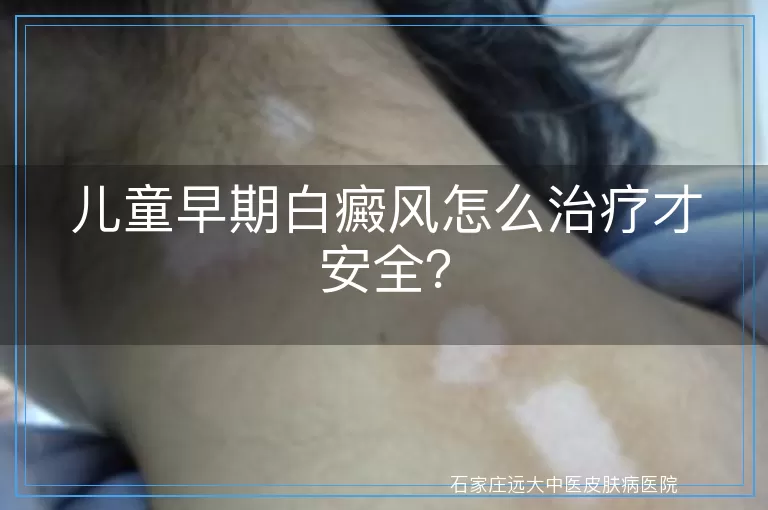 儿童早期白癜风怎么治疗才安全？