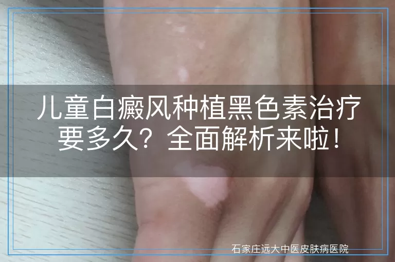 儿童白癜风种植黑色素治疗要多久？全面解析来啦！