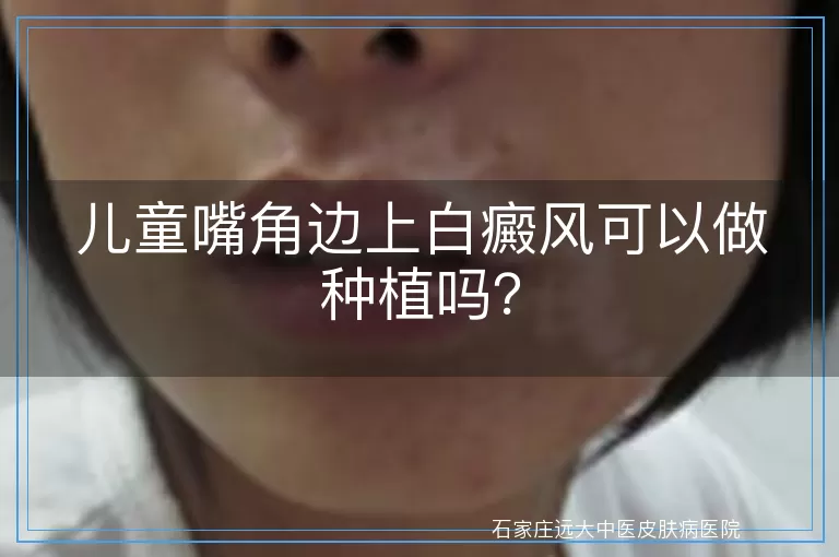 儿童嘴角边上白癜风可以做种植吗？