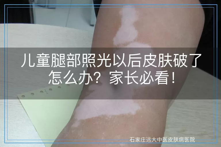 儿童腿部照光以后皮肤破了怎么办？家长必看！