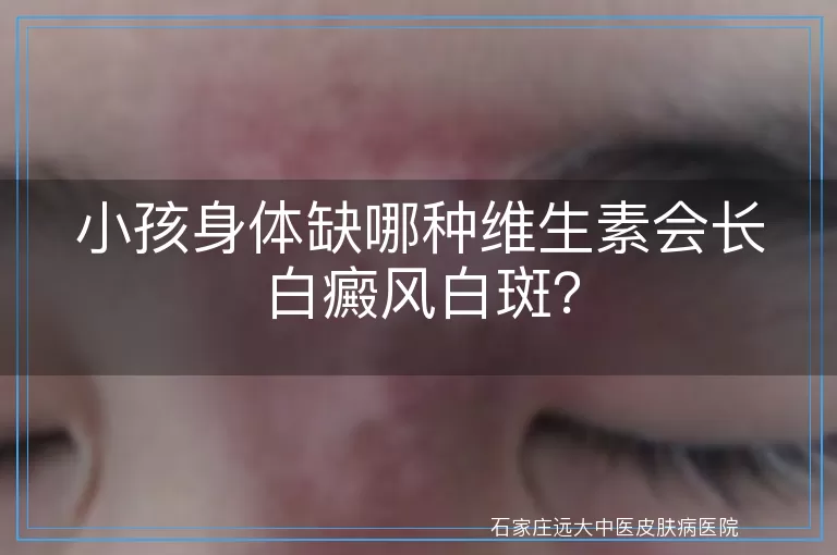 小孩身体缺哪种维生素会长白癜风白斑？
