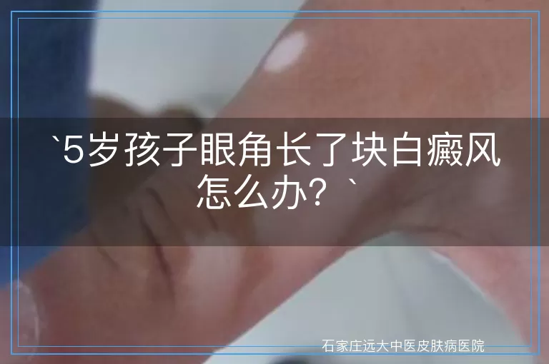 5岁孩子眼角长了块白癜风怎么办？