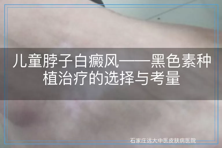 儿童脖子白癜风——黑色素种植治疗的选择与考量