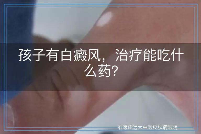 孩子有白癜风，治疗能吃什么药？
