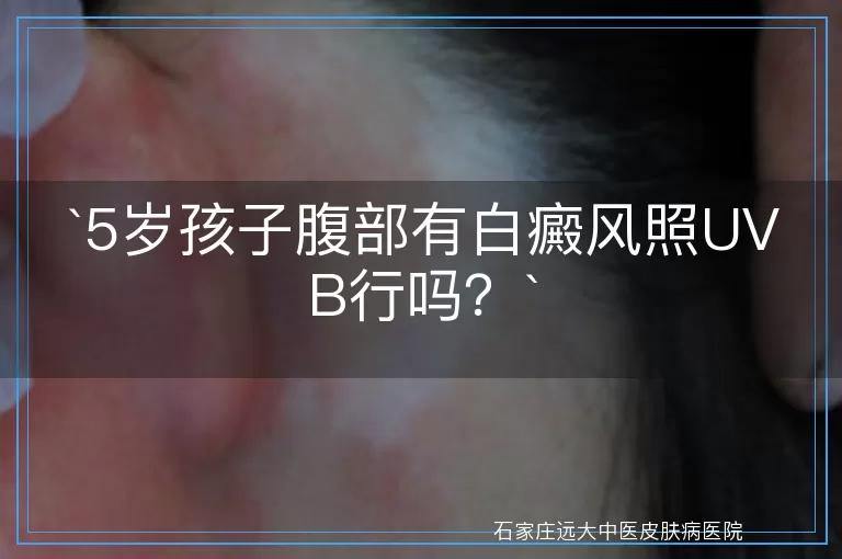 5岁孩子腹部有白癜风照UVB行吗？
