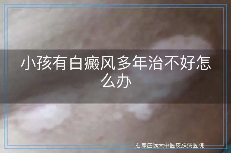 小孩有白癜风多年治不好怎么办