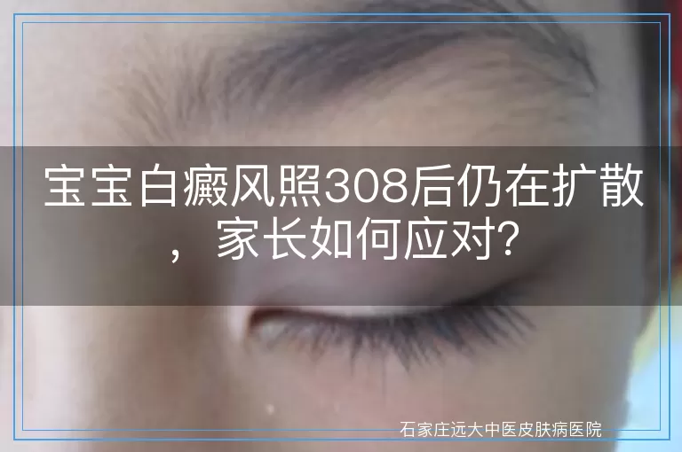 宝宝白癜风照308后仍在扩散，家长如何应对？