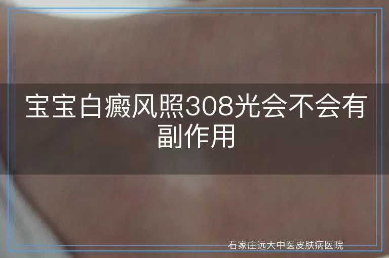 宝宝白癜风照308光会不会有副作用