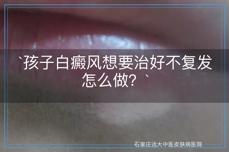 孩子白癜风想要治好不复发怎么做？