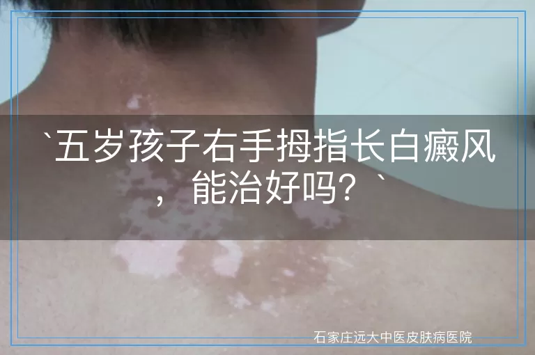 五岁孩子右手拇指长白癜风，能治好吗？