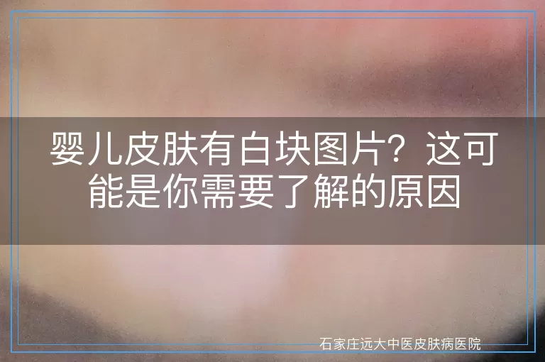 婴儿皮肤有白块图片？这可能是你需要了解的原因