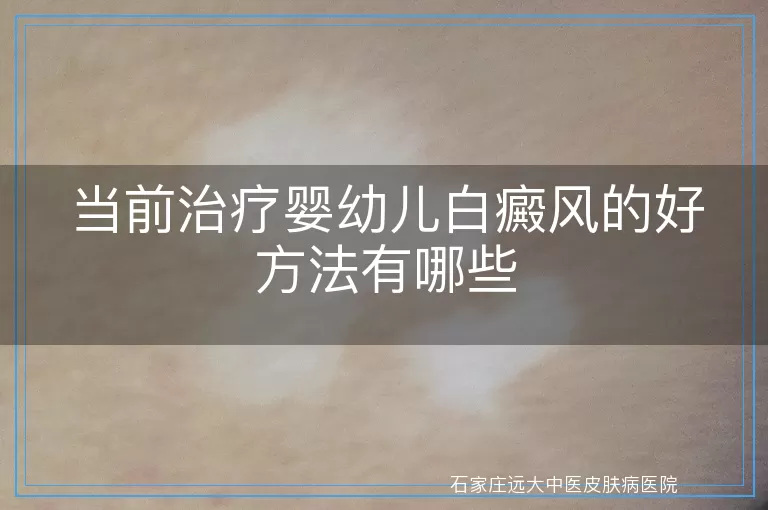 当前治疗婴幼儿白癜风的好方法有哪些