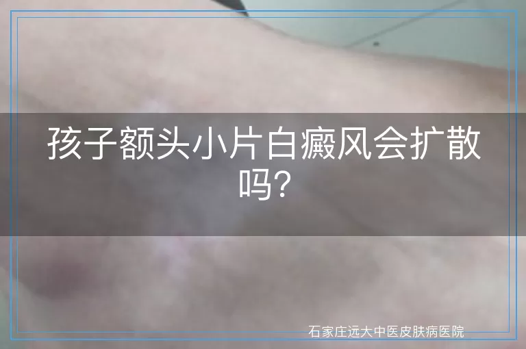 孩子额头小片白癜风会扩散吗？