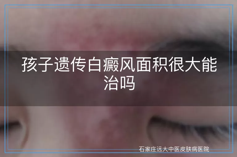 孩子遗传白癜风面积很大能治吗