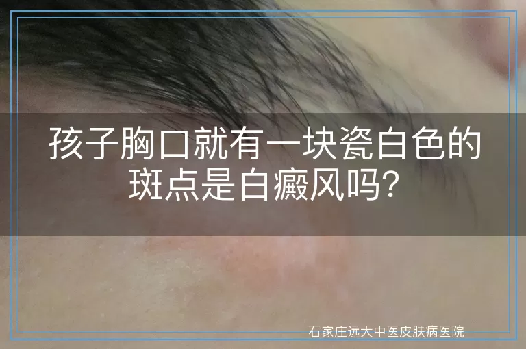 孩子胸口就有一块瓷白色的斑点是白癜风吗？