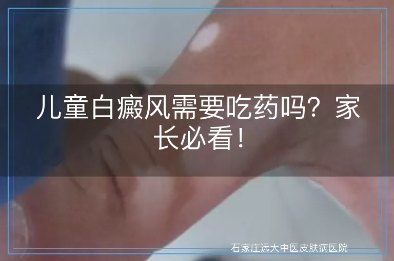 儿童白癜风需要吃药吗？家长必看！